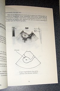 Cinésiologie utérine. Tests-traitement sous contrôle échographique